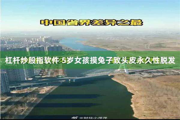 杠杆炒股指软件 5岁女孩摸兔子致头皮永久性脱发